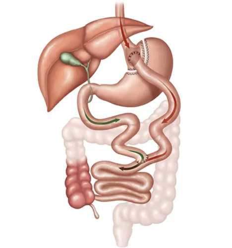 bypass-gastrique